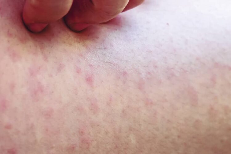 Alergias en piel a causa de Medicamentos
