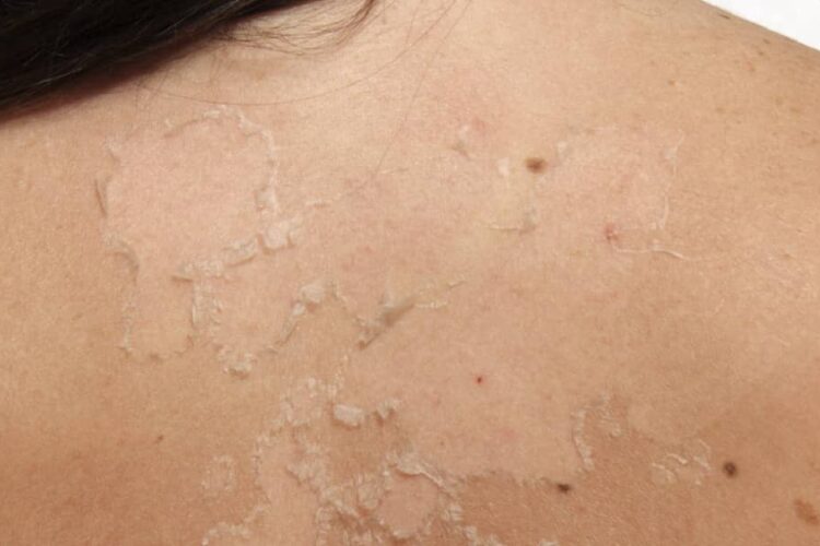 ¿Qué significa la descamación en la piel?