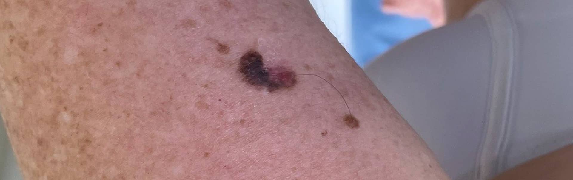 ¿Se puede prevenir el Melanoma?